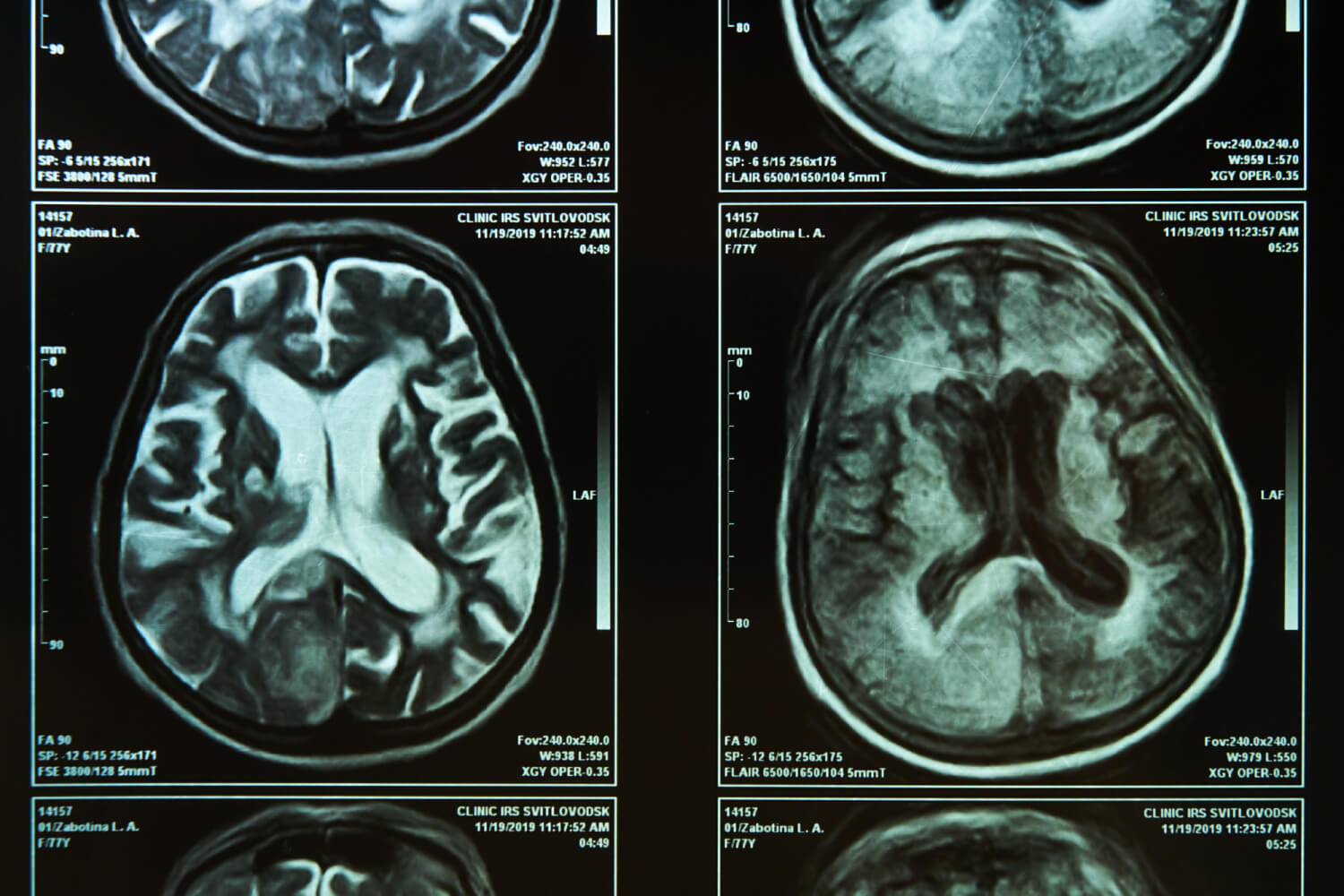 Brain MRI Scan Milton Keynes Private Neurological Imaging Vitalscan Brain MRI Scan Milton Keynes Private Neurological Imaging Vitalscan
