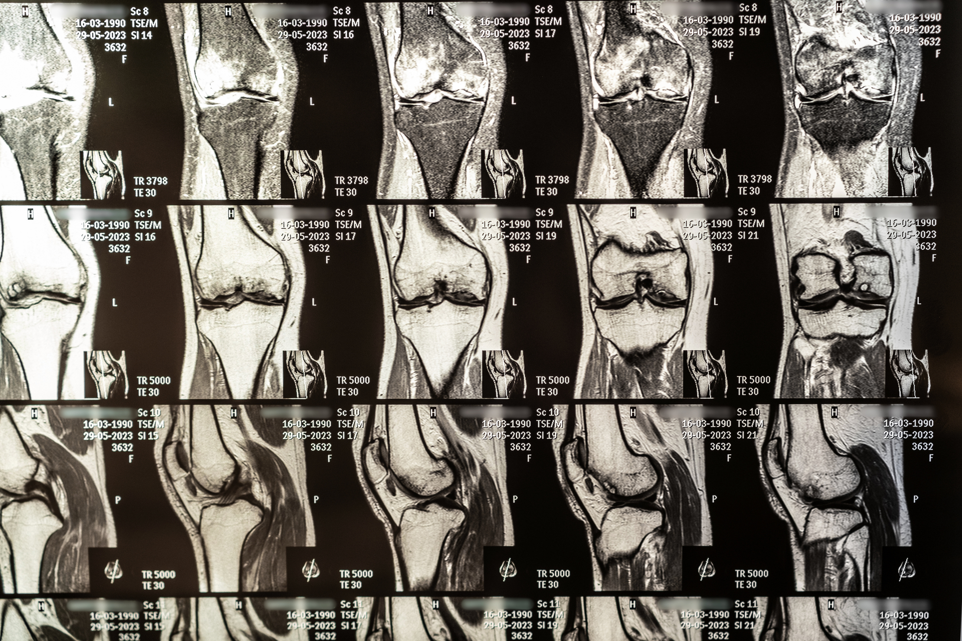 What is Knee MRI scan?