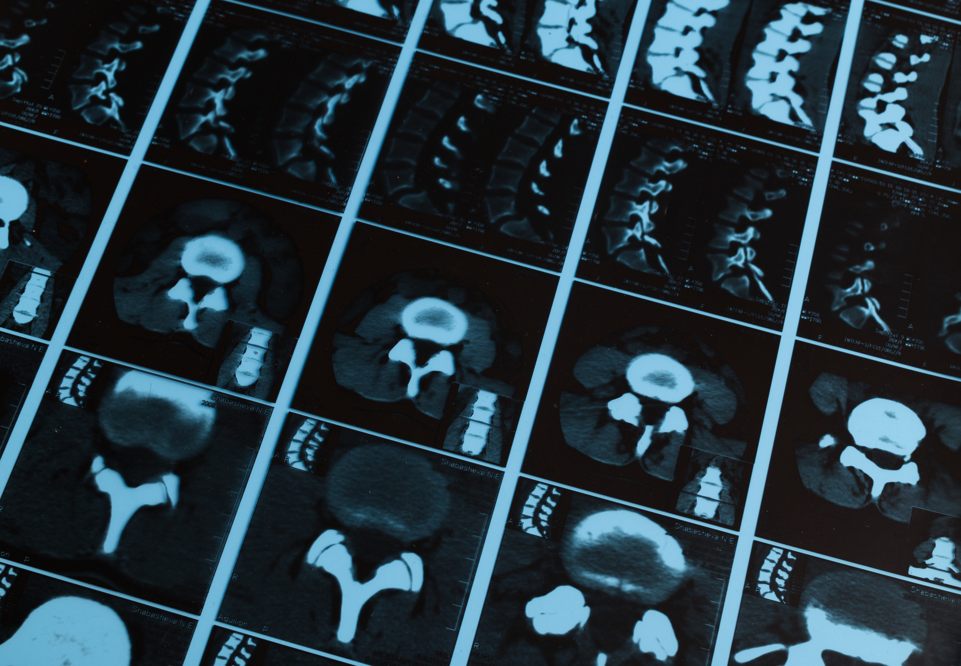 What is Spine MRI scan?