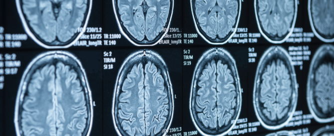 MRI brain scan images displayed on a light board showing multiple cross-sectional views of the brain.